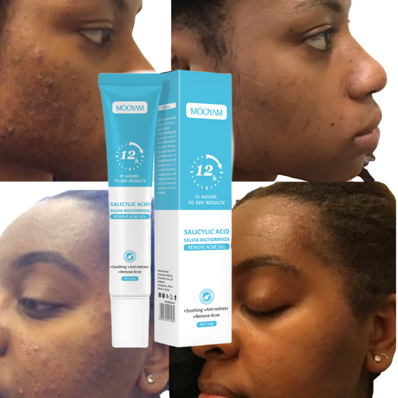 Gel Mooyam Anti-Acné Réparateur – Résultats visibles en 12h