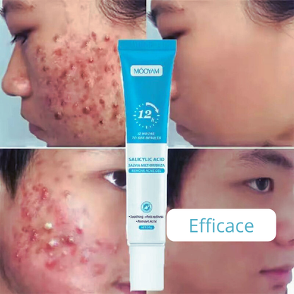 Gel Mooyam Anti-Acné Réparateur – Résultats visibles en 12h